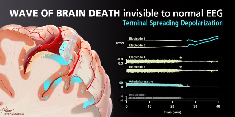 Terminal Spreading Depolarization And Electrical Silence In Brain Death ...